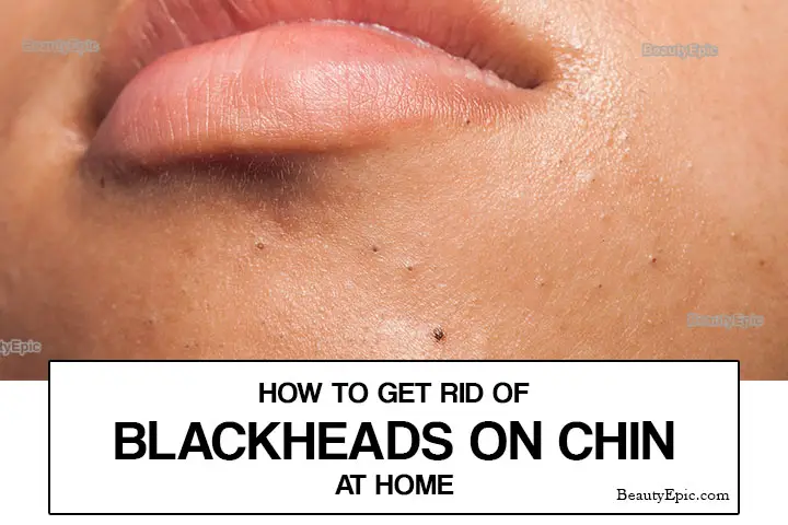 blackheads on chin