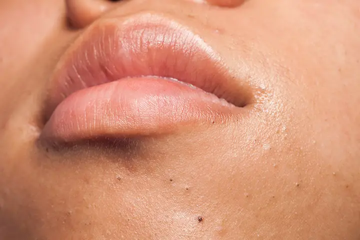 causes of blackheads on chin