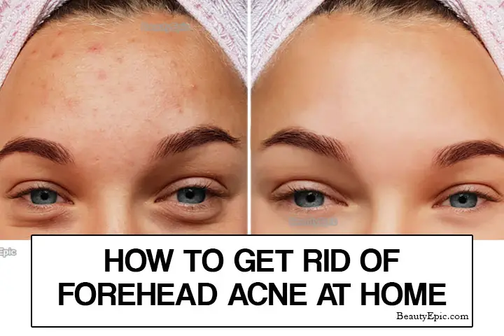 Forehead Acne