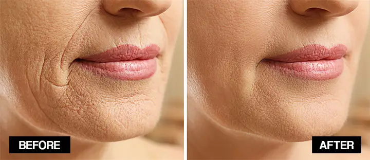 how to get rid of wrinkles around the mouth naturally