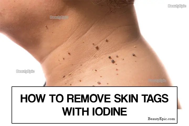 iodine for skin tags