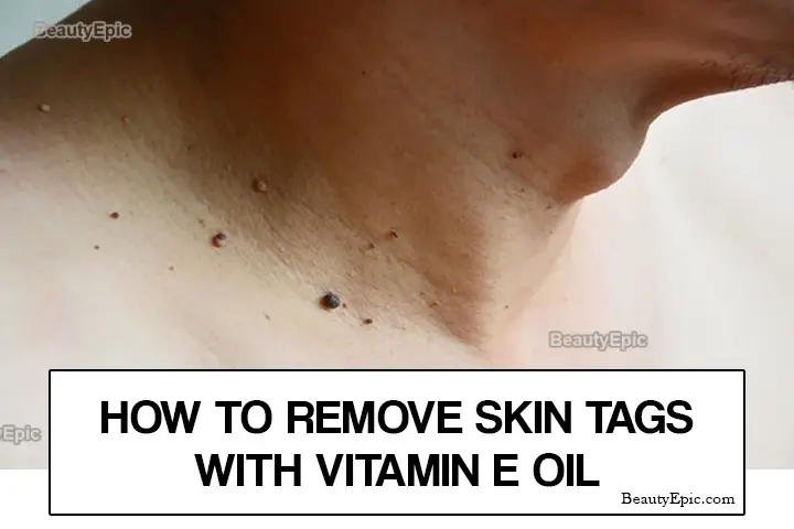 vitamin e oil for skin tags