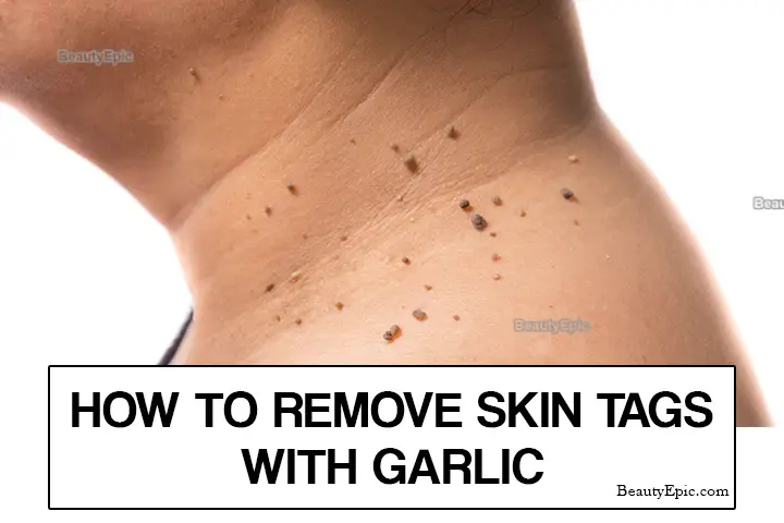 garlic for skin tags
