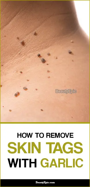 how to remove skin tags with garlic
