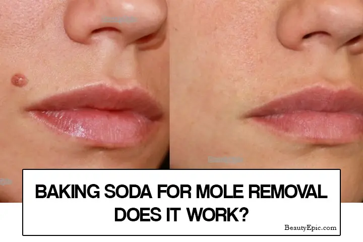 baking soda for moles