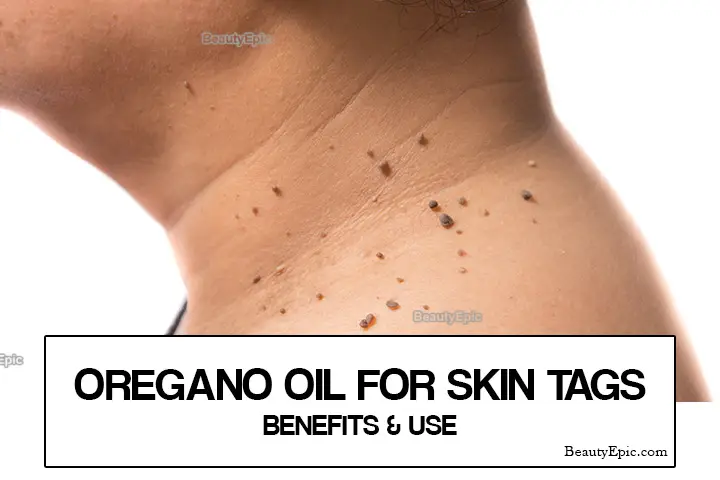 oregano oil for skin tags