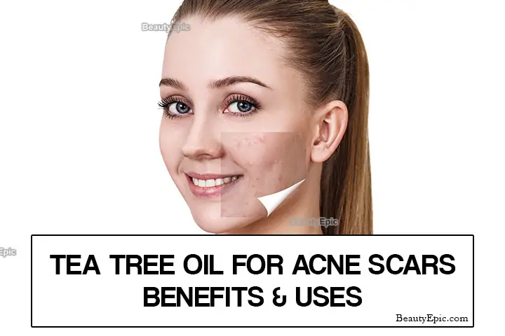 tea tree oil for acne scars