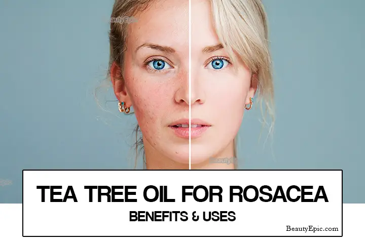 tea tree oil for rosacea