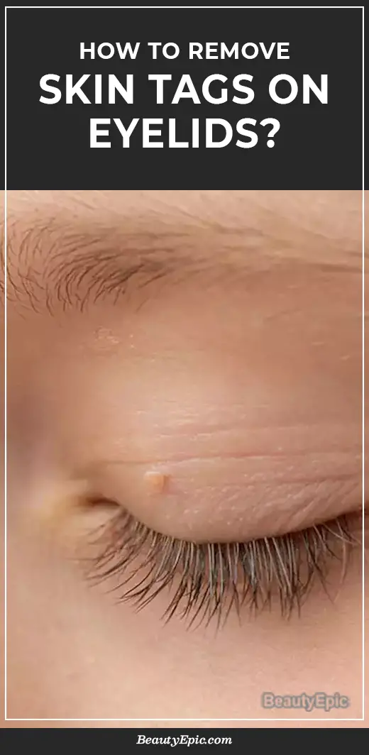 skin tags on eyelids