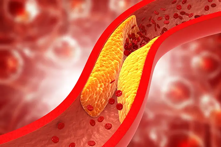 foods to prevent clogged arteries