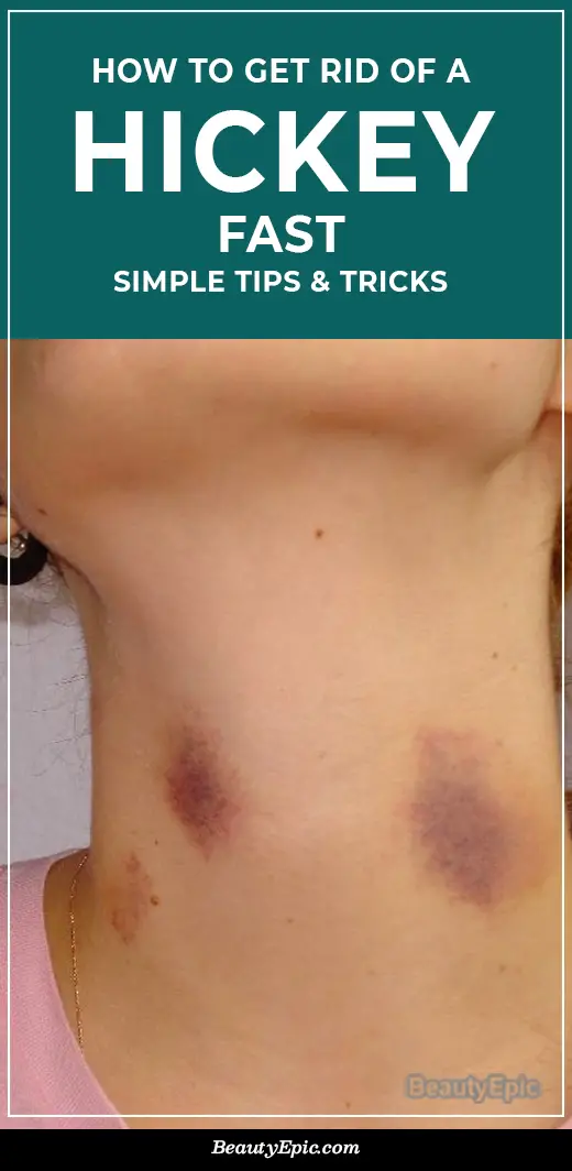 How to Get Rid of a Hickey Fast 10 Simple Tips and Tricks