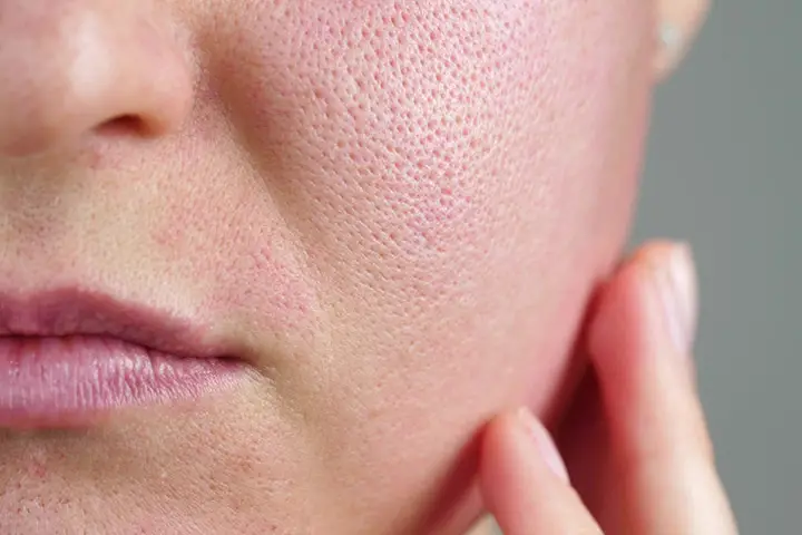 how to get rid of open pores on face