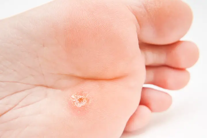 how to get rid of warts