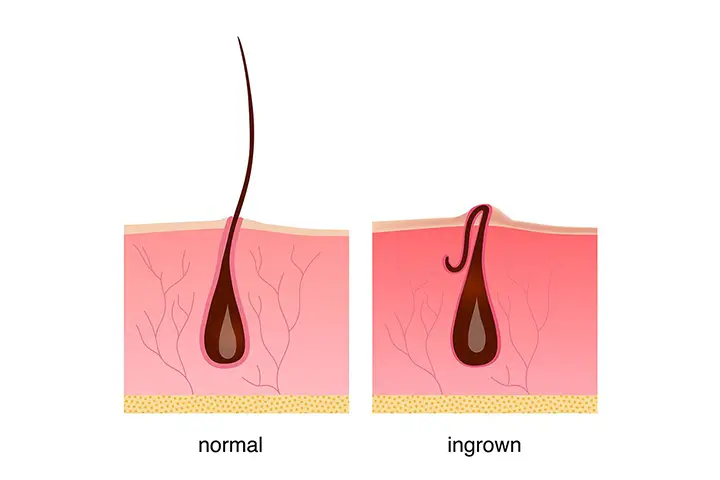 ingrown hair on the legs