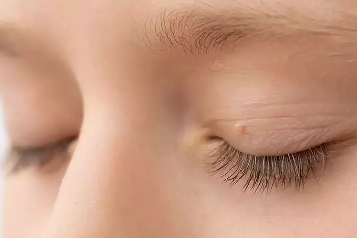 skin tags on eyelids