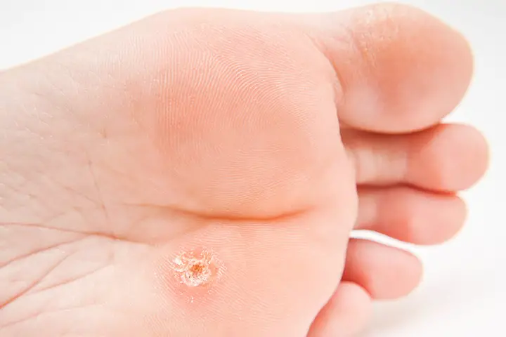 baking soda and castor oil for warts
