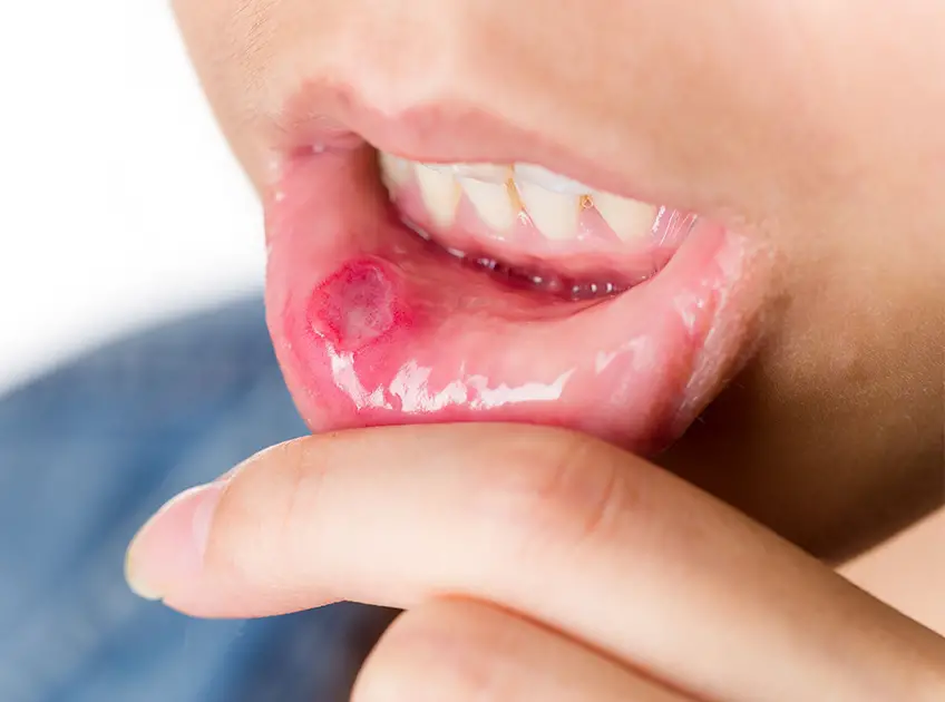 Home Remedies for Canker Sores