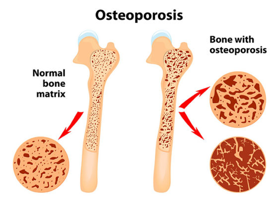 Osteoporosis Home Remedies