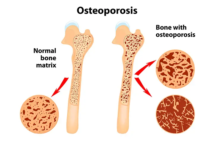 Osteoporosis Home Remedies