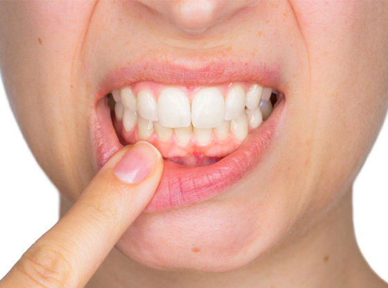 best Home Remedies for Gum Disease