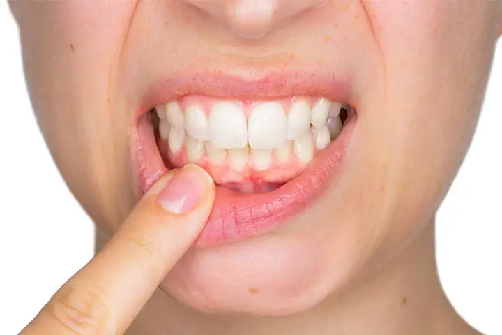 best Home Remedies for Gum Disease