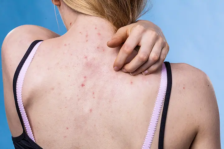 how to get rid of back acne scars