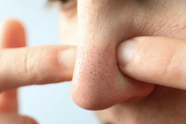 how to remove blackheads for oily skin