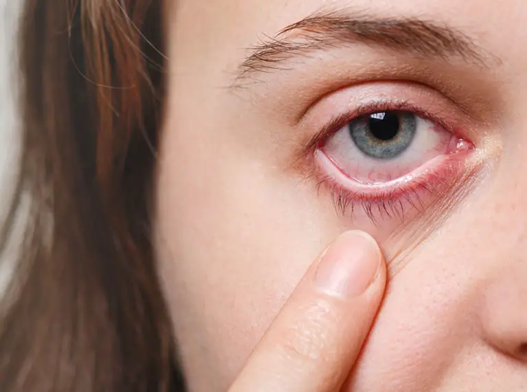 Home Remedies for Pink Eye
