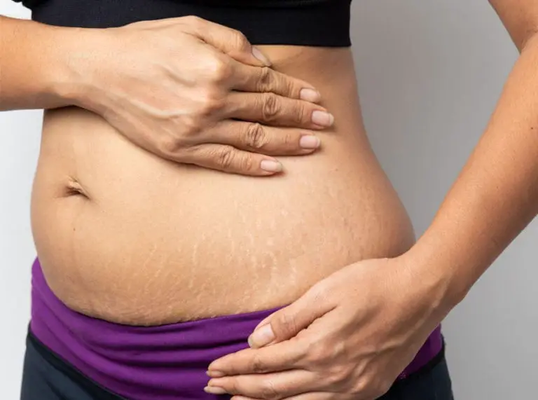 can Baking Soda and Lemon Remove Stretch Marks