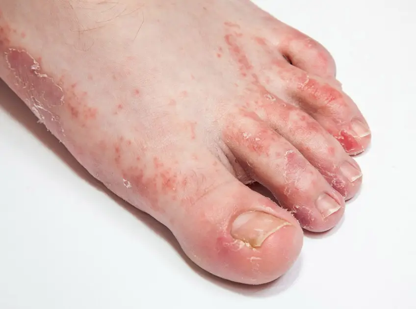 Apple Cider Vinegar and Baking Soda for Athlete's Foot