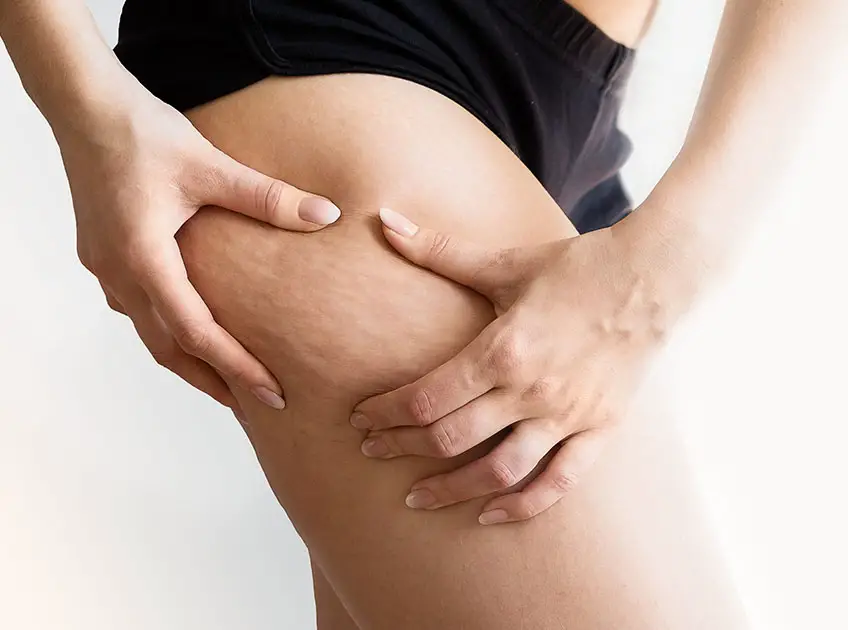 Coconut oil and Baking Soda for Cellulite