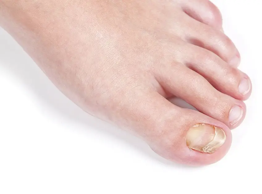 epsom salt and apple cider vinegar for toenail fungus