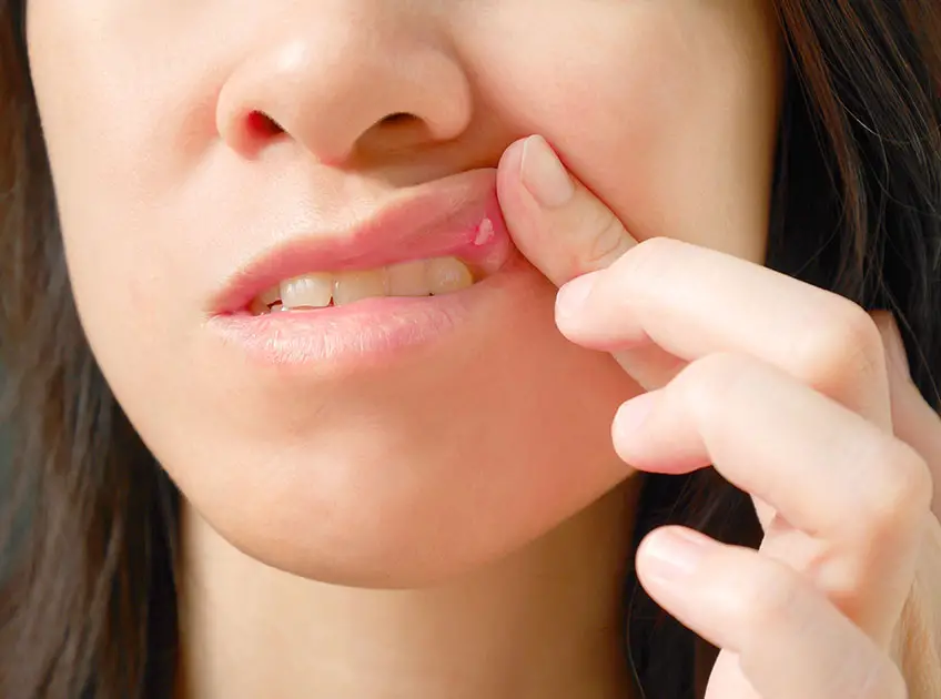 Essential Oils for Canker Sores