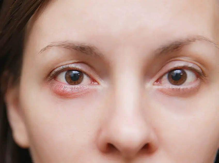 how to get rid of stye