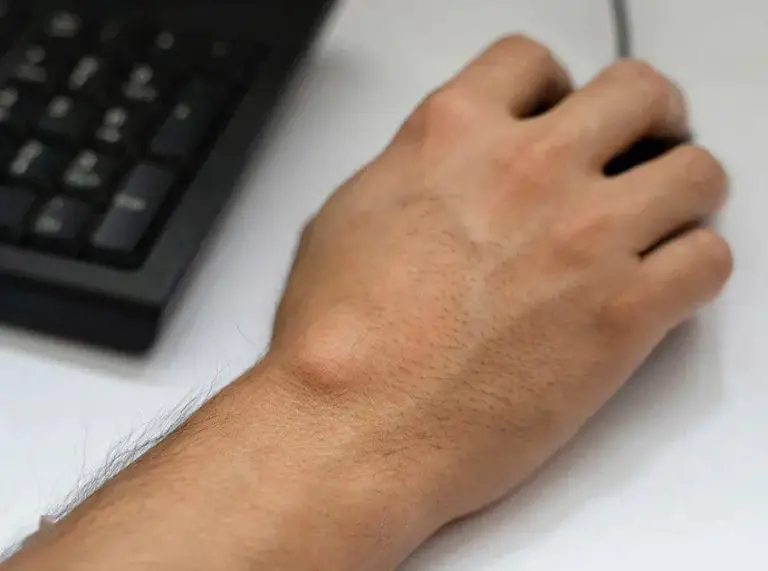 7 Best Essential Oils For Ganglion Cyst