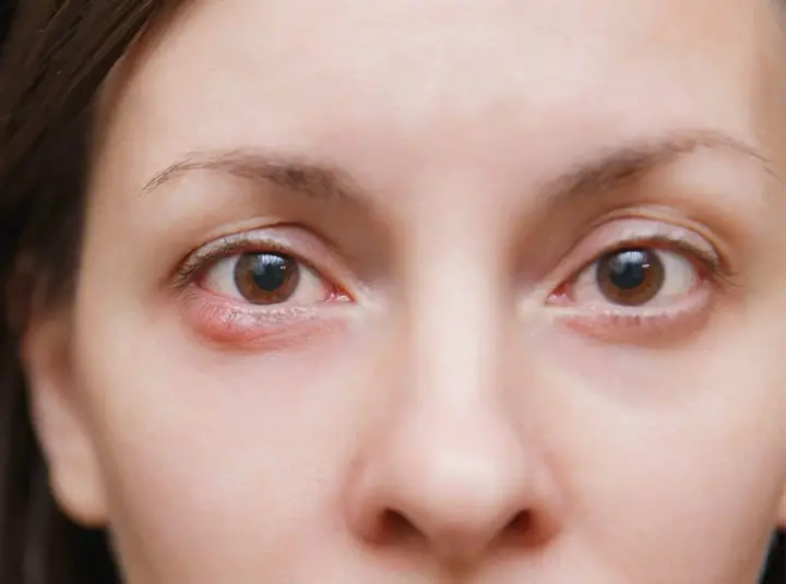 Essential Oils For Eye Stye