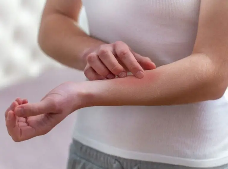 Coconut Oil For Jock Itch