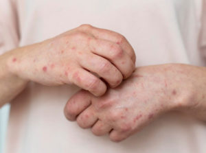 7 Best Essential Oils for Eczema Treatment