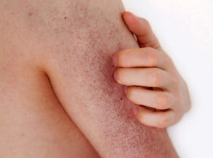 The 7 Best 6 Essential Oils for Keratosis Pilaris,