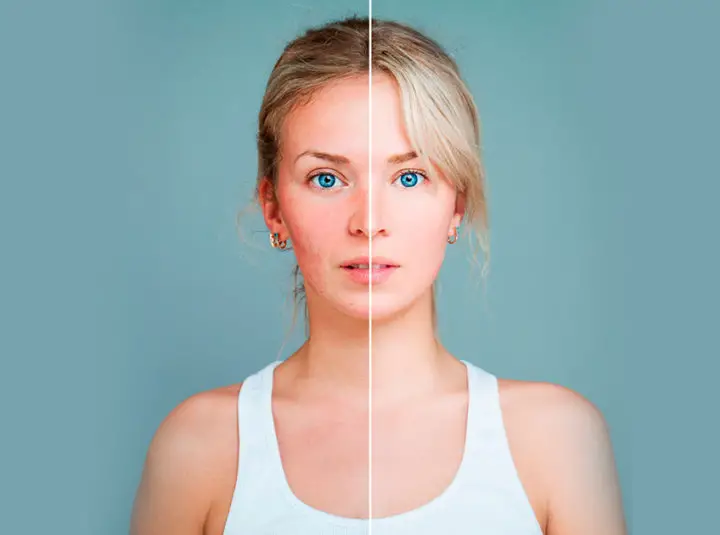 How To Use Coconut Oil For Rosacea?