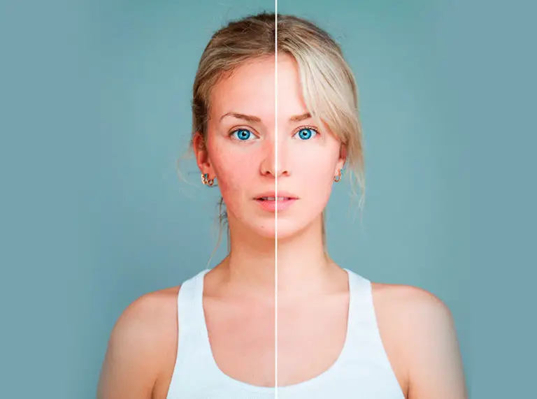 How To Use Coconut Oil For Rosacea?