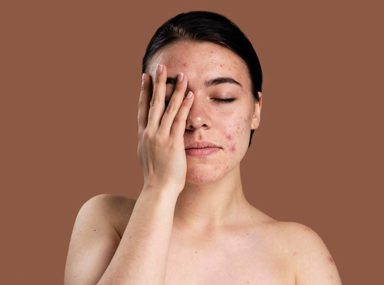 8 Effective Home Remedies for Acne and Pimples