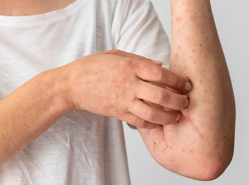 home remedies for eczema