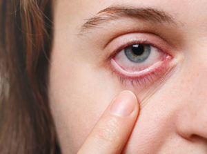 home remedies for eye infection