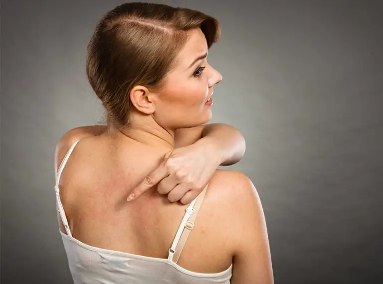 10 Effective Home Remedies For Skin Allergies