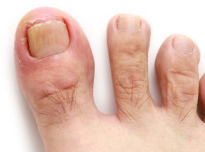 quick remedies for ingrown toenails