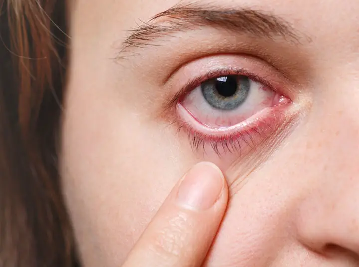 Why Do My Eyes Get Red Or Watery After A Shower?